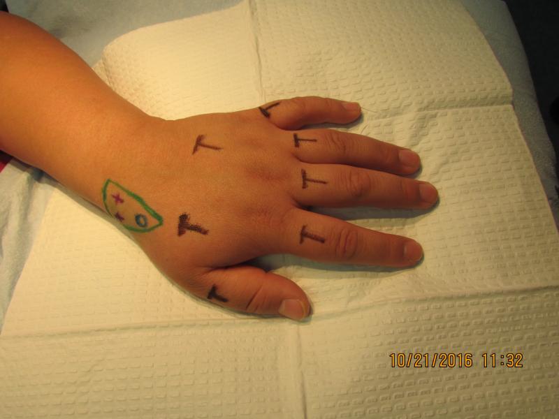 Nerve identified & marked by 'X'. 